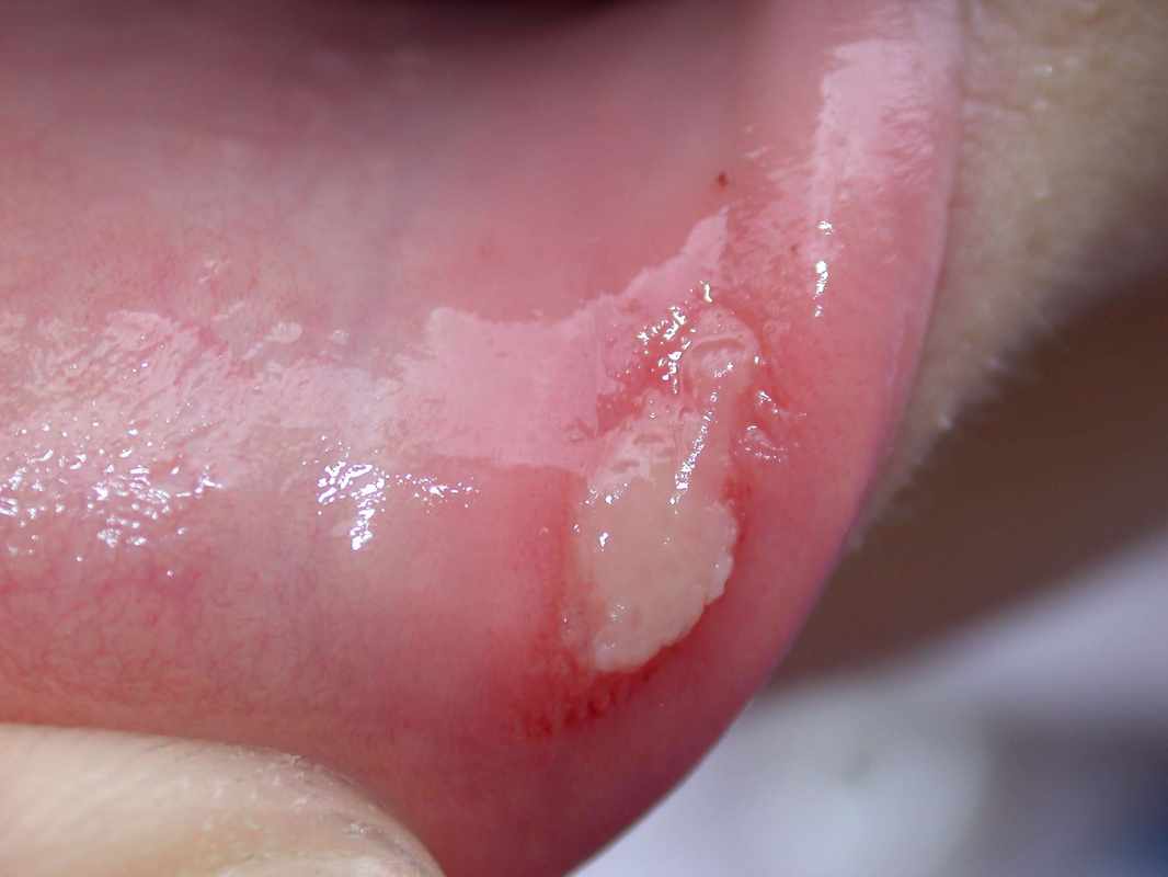 What Is a Canker Sore on the Penis Head_