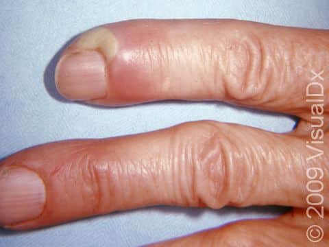 What is a Bump on Finger Near Nail_ Causes_ Treatment _ Prevention