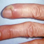 What_is_a_bump_on_finger_near_nail_causes_treatment_prevention