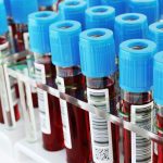 What_is_an_amylase_or_lipase_blood_test