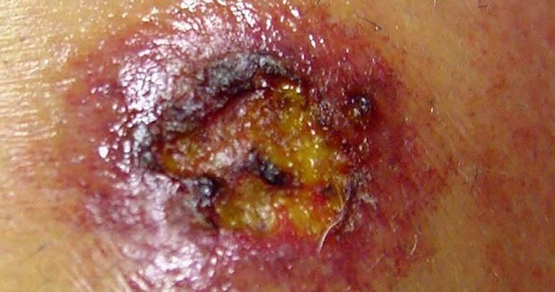 bites of Brown Recluse Spider