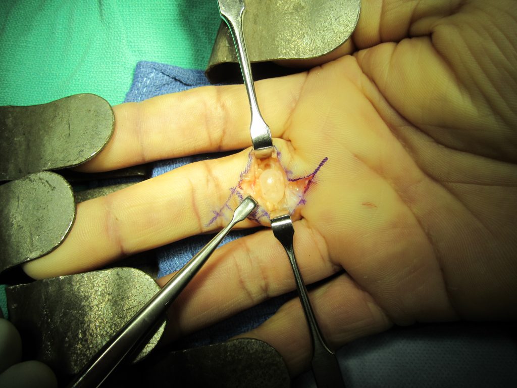bump On Inside Of Finger Joint