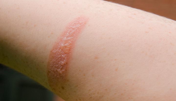 caring for Second Degree Burns