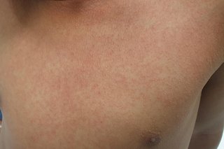 child Has Rash On Chest Strep Throat