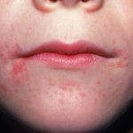 4_year_old_pimples_around_mouth