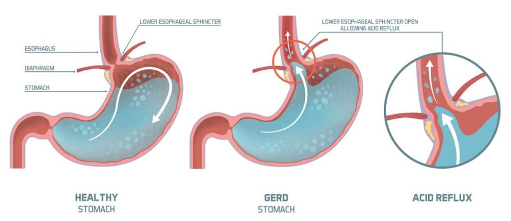 Acid Reflux_ Blood Taste in Mouth