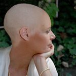 After_chemo_bumps_on_scalp