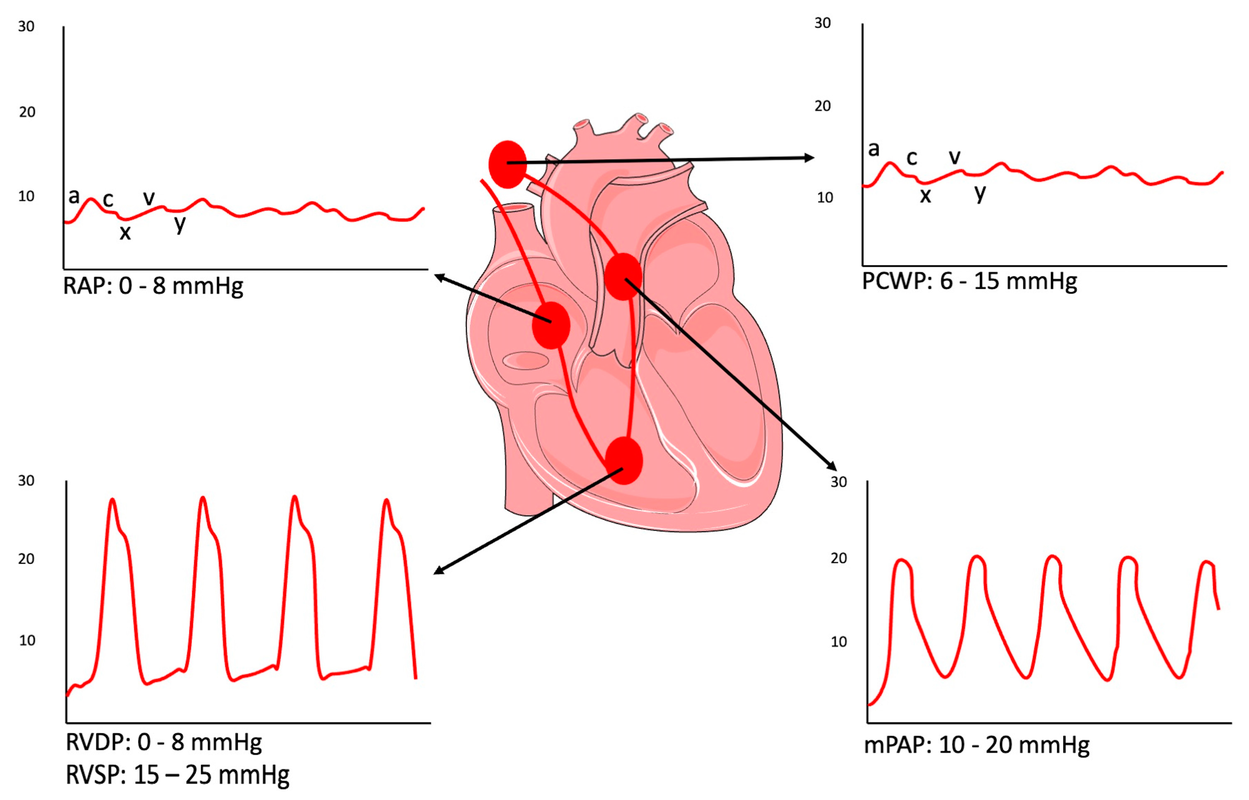 Atrial Fibrillation with Right Ventricular Rupture Nursing