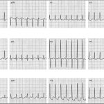 Atrial_fibrillation_with_rhythm_variables_icd-10