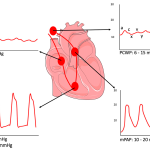 Atrial_fibrillation_with_right_ventricular_rupture_nursing