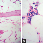 Azathioprine_bone_marrow_suppression