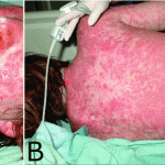 Bactrim_toxic_epidermal_necrolysis