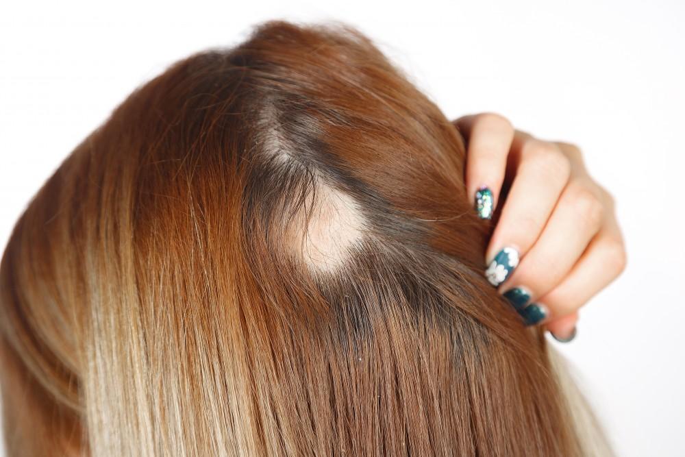 Bald Spot On Head