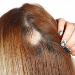 Bald_spot_on_head