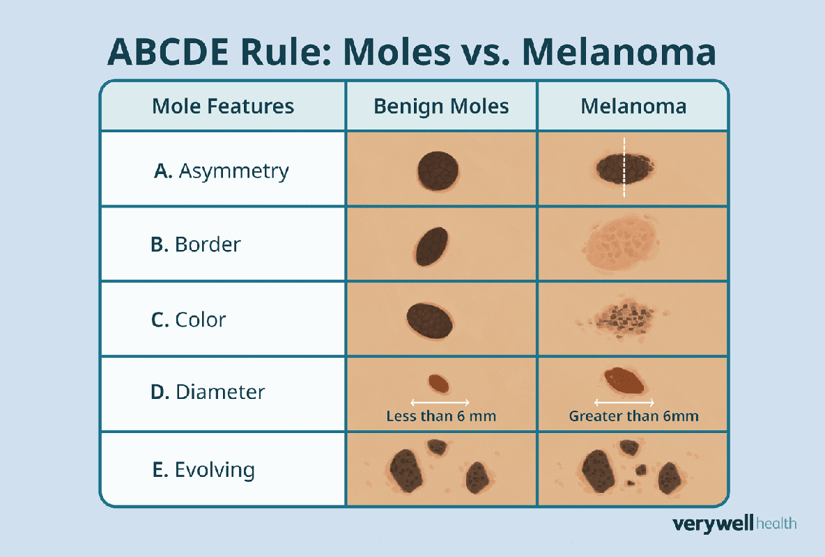 Benign Moles vs Malignant Moles_ Understanding the Difference