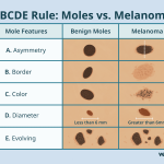 Benign_moles_vs_malignant_moles_understanding_the_difference