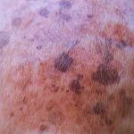 Black_moles_on_dogs_skin_understanding_the_condition