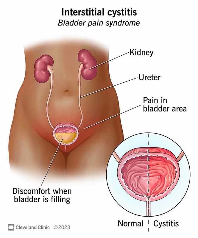 Bladder Side Effects of Amitriptyline_ A Comprehensive Overview