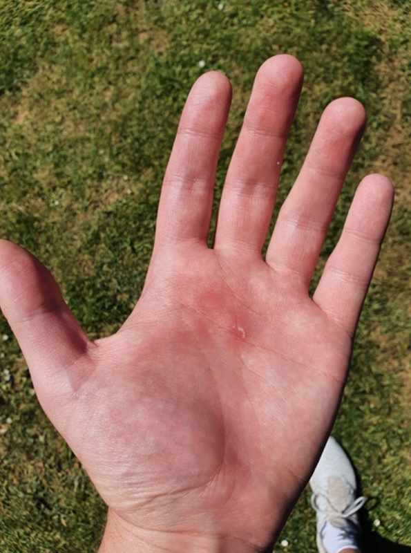 Blister On The Palm Of My Hand