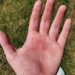 Blister_on_the_palm_of_my_hand