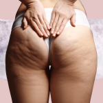Butt_crack_itchy_expert_solutions_for_your_uncomfortable_issue