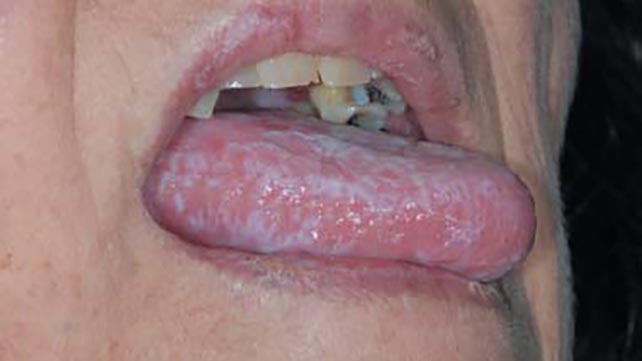 CBD Oil for Oral Lichen Planus