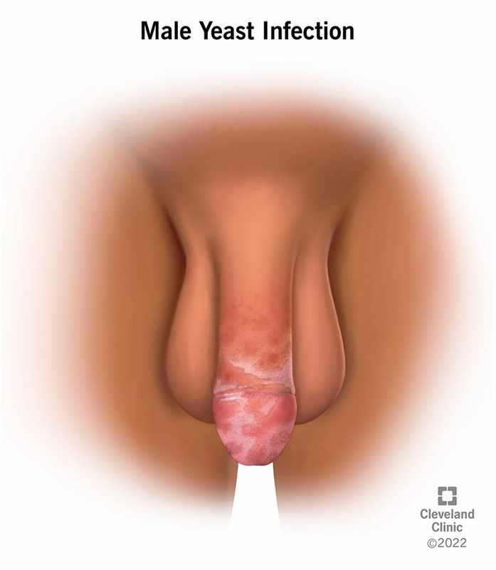 Can Men Catch a Yeast Infection_