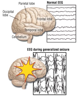 Can an EEG Cause a Grand Mal Seizure_