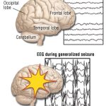Can_an_eeg_cause_a_grand_mal_seizure
