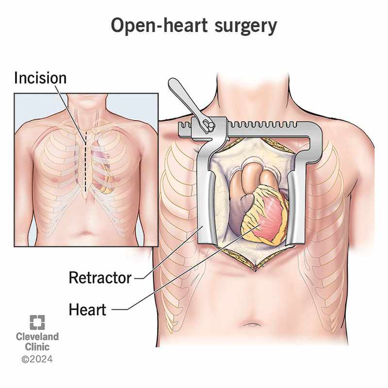 Chronic Chest Pain After Triple Bypass Surgery
