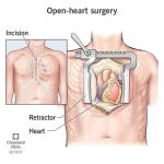 Chronic_chest_pain_after_triple_bypass_surgery