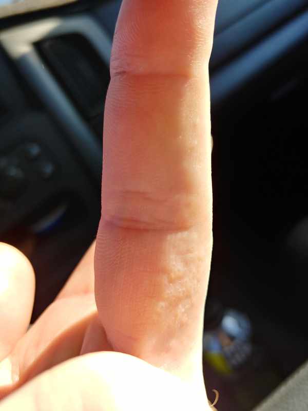 Clear Bumps on Side of Fingers