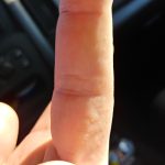 Clear_bumps_on_side_of_fingers