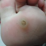 Clogged_sweat_glands_in_feet_pictures_of_fungal_infections
