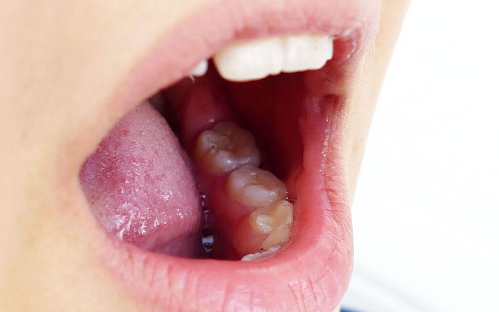 Discovering Bumps On Jaw In Back Of Mouth_ Causes And Treatment Options