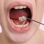 Displacing Teeth A Bump in My Mouth_1