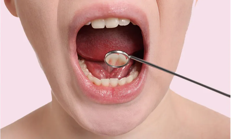 Displacing Teeth_ A Bump in My Mouth