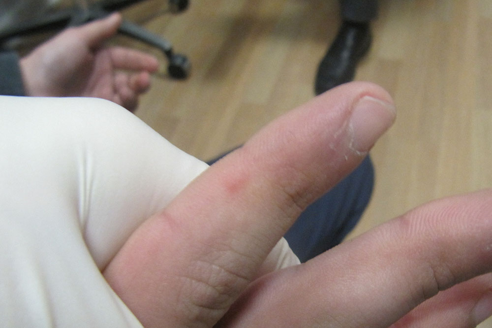 Getting Rid of Bumps on Sides of Fingers
