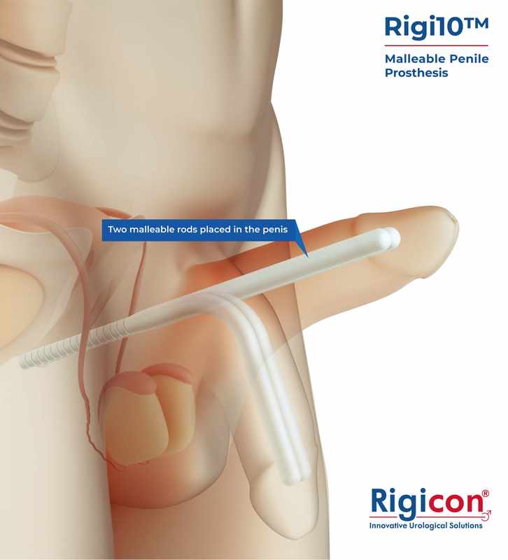Ideal Solutions for 5 Inch Penis Extenders