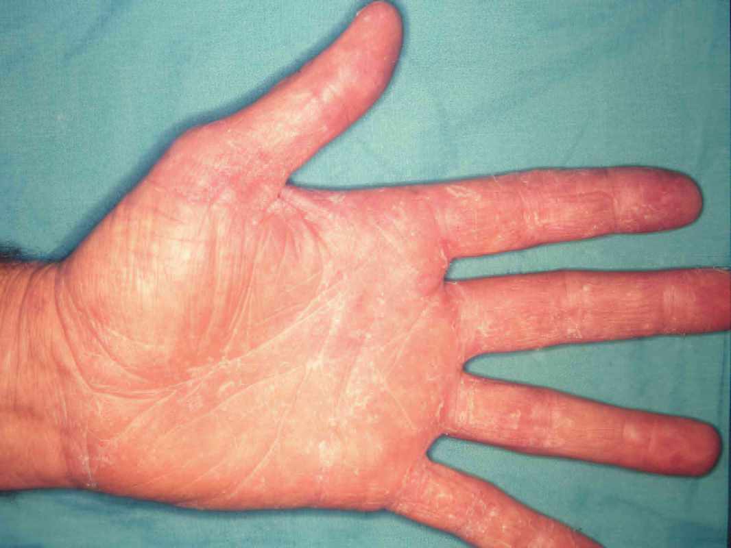 Pictures of Athletes Foot on Hands