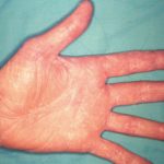 Pictures_of_athletes_foot_on_hands
