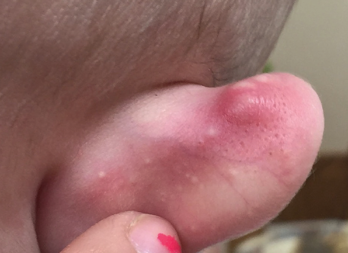 Red Bumps on Head of Penis