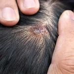 Scalp Bumps Filled With Blood Understanding the Cause and Treatment_1