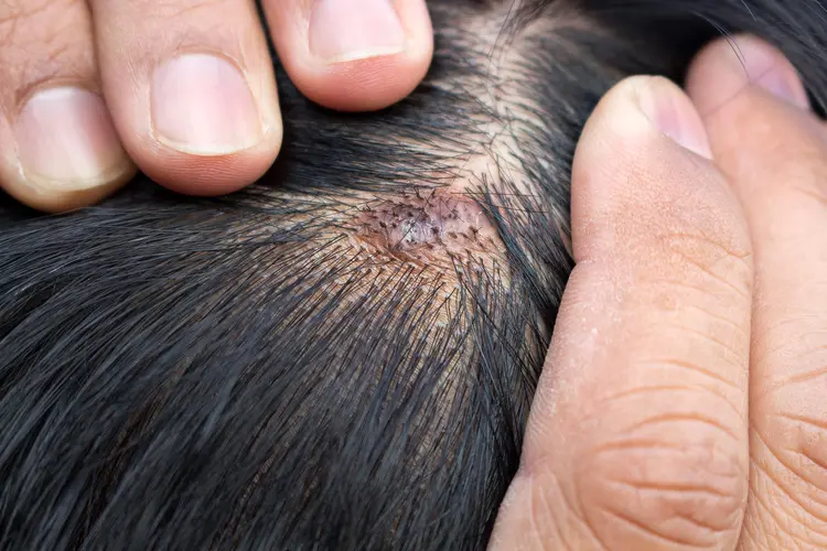 Scalp Bumps Filled With Blood_ Understanding the Cause and Treatment