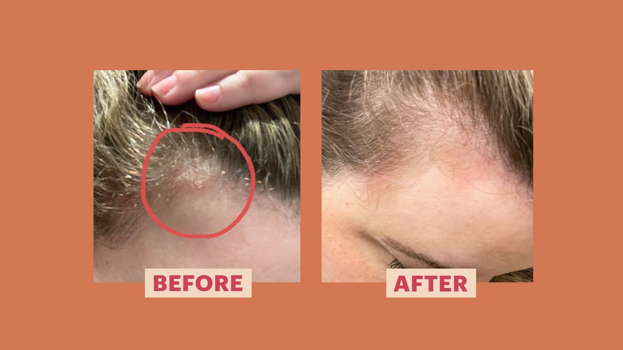 Scalp Treatment_ Clobetasol Propionate Cream