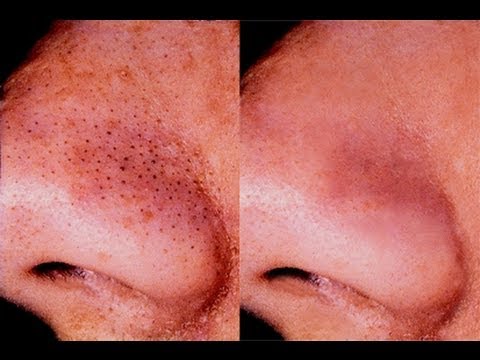 The Best Way to Get Rid of Blackheads on Sensitive Skin