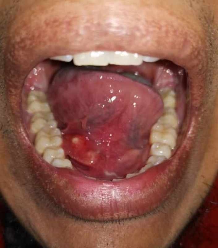 The Bump On Floor Of My Mouth