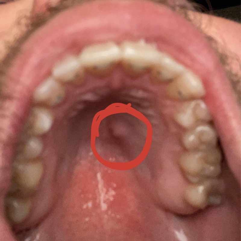 The Bump on the Roof of My Mouth Hurts