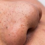 The_best_way_to_get_rid_of_deep_blackheads