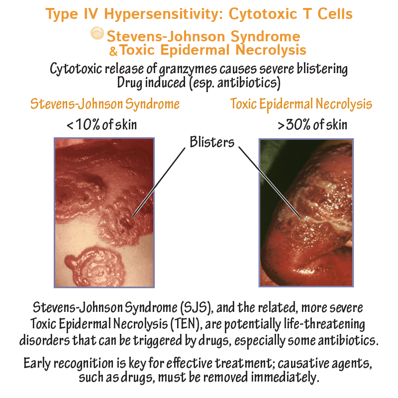 Toxic Epidermal Necrolysis Associated with Bactrim Use